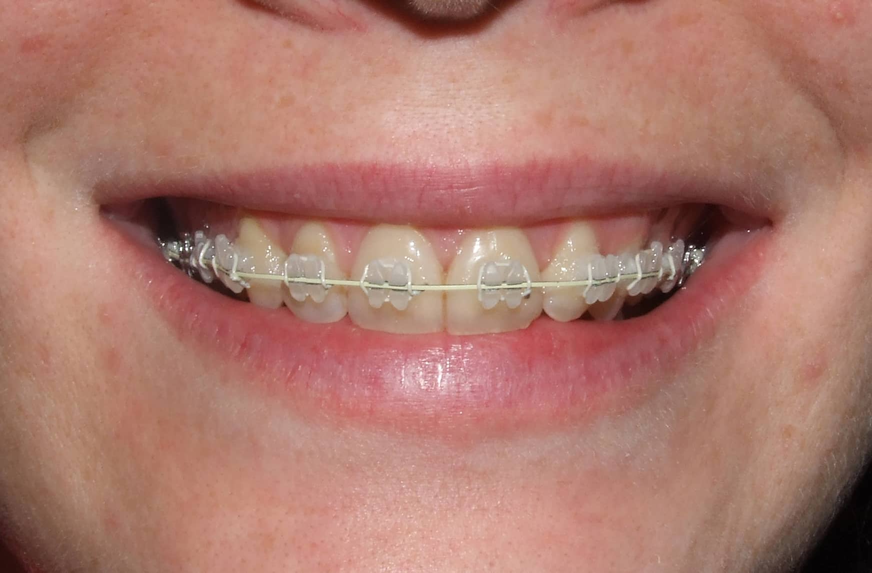 ortodoncia zafiro cerámico